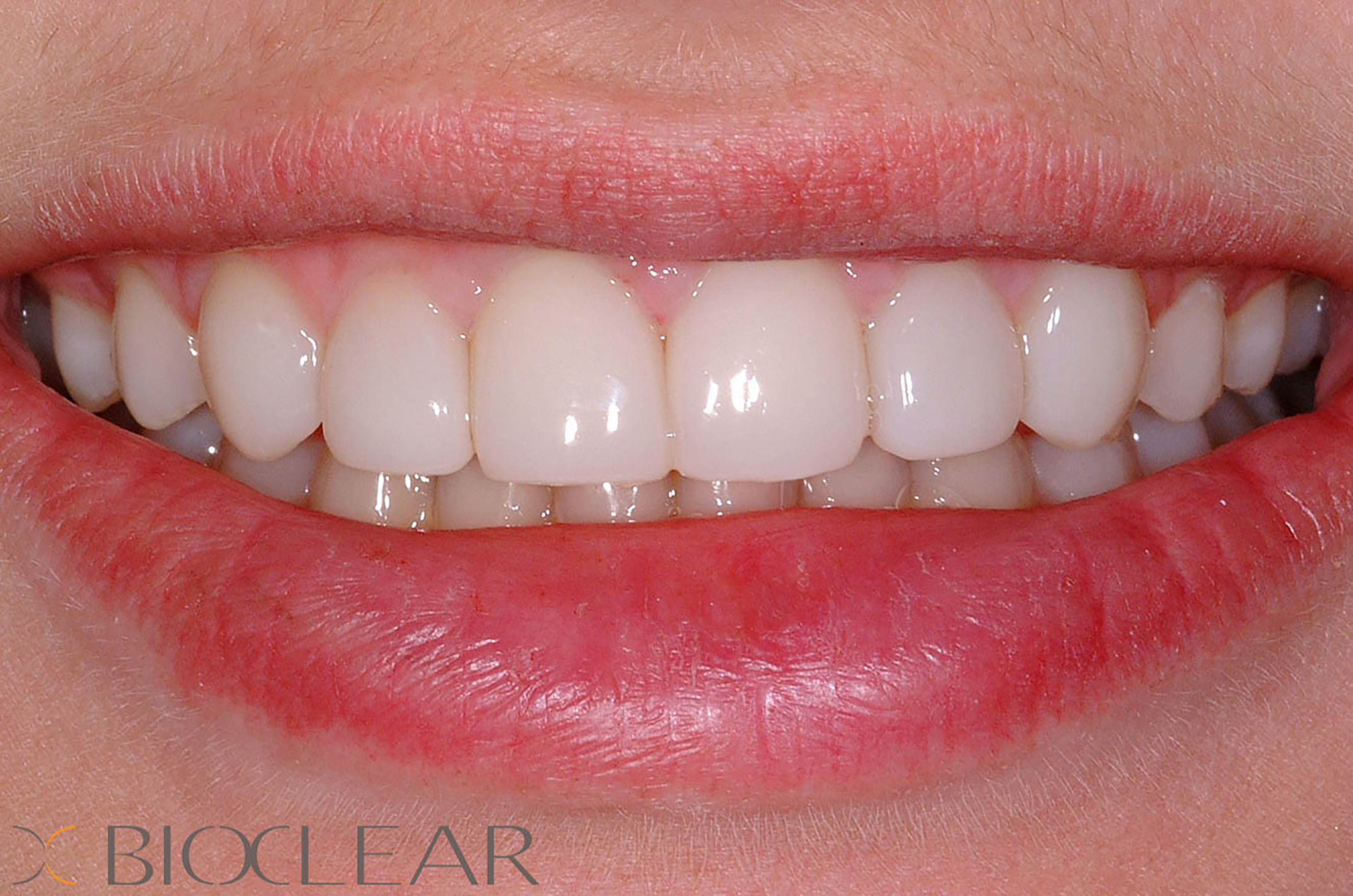 BioClear Lateral Bonding After