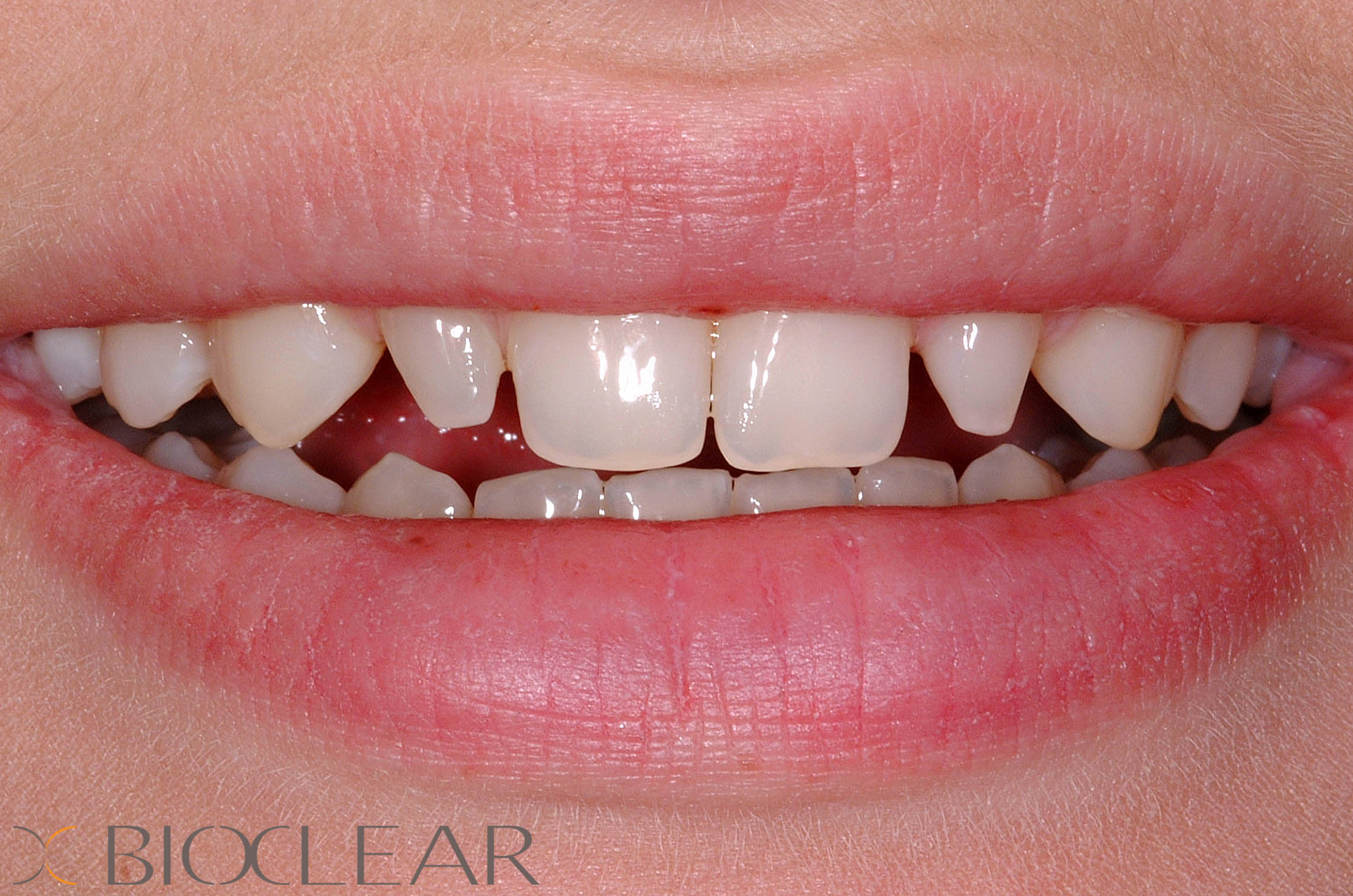 BioClear Lateral Bonding Before