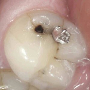 Patient Case: Amalgam Filling & Decay