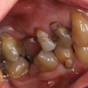 Patient Case: Broken & Damaged Teeth Before
