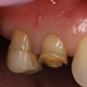 Patient Case: Broken Teeth Before