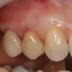 Patient Case: Broken Teeth After